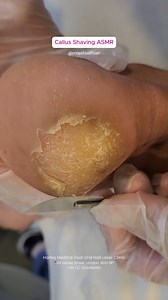 👣 Smooth feet in minutes! Watch as we safely remove stubborn calluses and restore your soft, healthy skin. ✨ 🔥 Tired of rough, cracked heels or callused feet? It’s time for a transformation! Say goodbye to discomfort and hello to confidence! Visit our website for more info: https://www.footcliniclondon.co.uk/ #missfootfixer #callustoday #podiatry #podiatrist #satisfying | Miss Foot Fixer