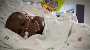 Risky surgery separates parasitic twin