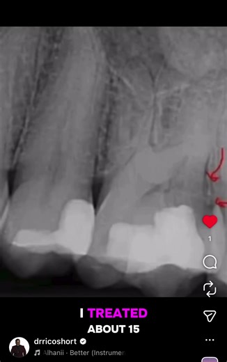 Can ProRoot MTA Be Used Non- Surgically For Supracrestal External Cervical Resorption? Will It Wash Out? #drricoshort #endodontickeysandcases #dentistry #MTA #retreatment
