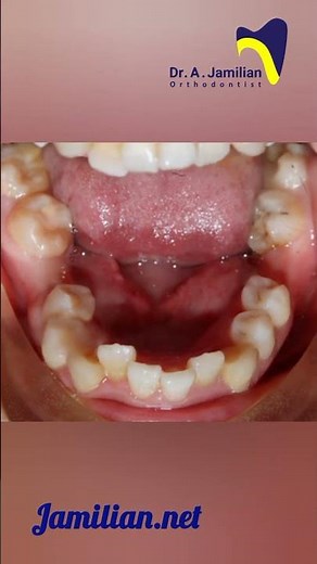 Alignment of crooked teeth with fixed orthodontic treatment. #dentist #orthodontics #braces #fixed