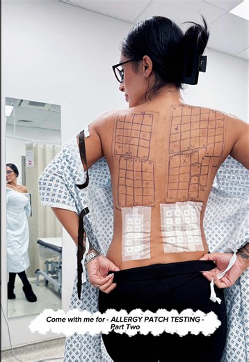 Allergy Patch Testing Journey: Day 2 and 3 Insights