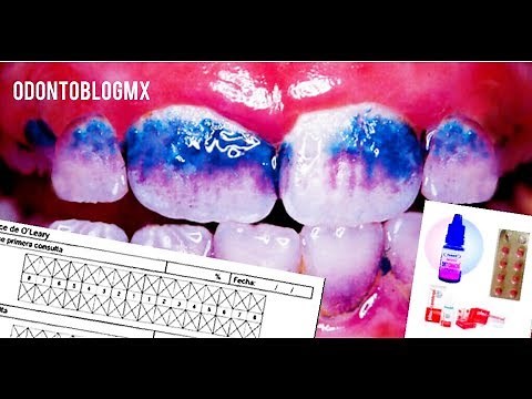 O'Leary Index