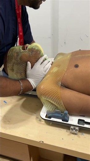 live Demo of Mask Making for Radiation Therapy #ytviral #ytshorts