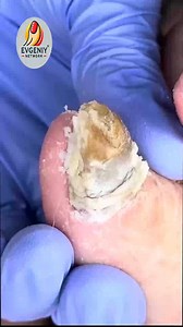 80K views · 381 reactions | Smart Health Tips for Thickened Toenails With Doctor-Approved Steps #DiabeticFootCare #HealthyHabits #FootCareTips | Evgeniy | Facebook