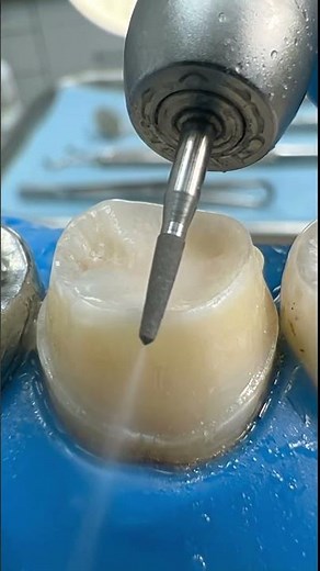 Satisfying ASMR Tooth Reshaping an uneven tooth. #dentist #dentalrestoration