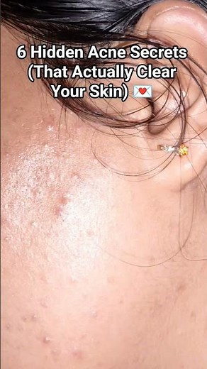 How to Clear Acne Faster: 6 Secrets Science Revealed 🧪 #acnetreatment #clearskinjourney#acneskincare