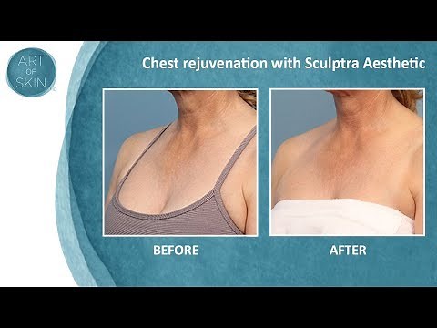 Sculptra chest rejuvenation of décolletage