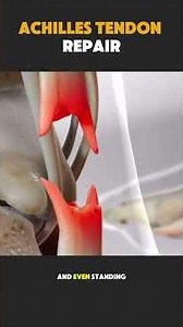 Achilles Tendon Repair Surgery Explained | Step-by-Step Procedure #orthopedicsurgery #footsurgery