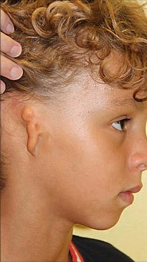 Born Without Ears? 😱 The Shocking Truth About Microtia! #Microtia #RareDisease #MedicalFacts #yt