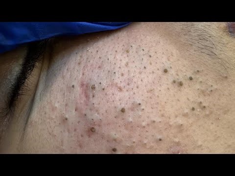 [ASMR] Deep Cleansing Facial, Whitehead And Blackheads Removal Techniques