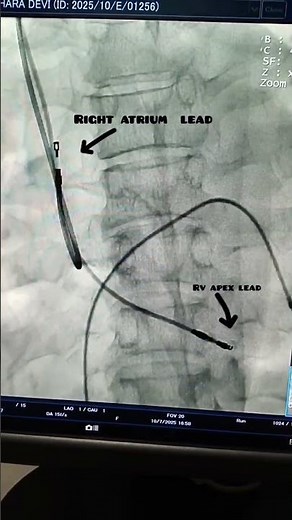 Synchronized care :Double chamber pacemaker