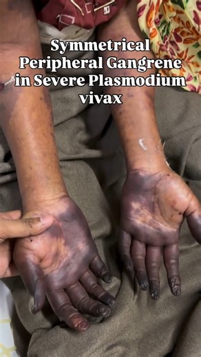 Schoolof Biology on Instagram: "See what Pernicious Malaria Can do to You: . Symmetrical peripheral gangrene (SPG) is defined as symmetrical distal ischemic change at two or more sites in the absence of any vasculitis or large‑vessel obstruction. SPG caused by malaria is very rare, and most of the cases are associated with Plasmodium falciparum. Herein, we present a case of SPG due to severe Plasmodium vivax malaria. All peripheral pulses including dorsalis pedis were palpable. Prothrombin time 