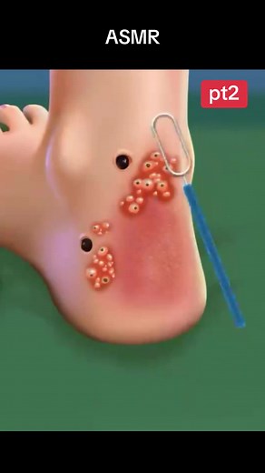 pt. Parasite ankle #asmr #parasite #extractions #happyhospital #fyp #disgustingsatisfaction