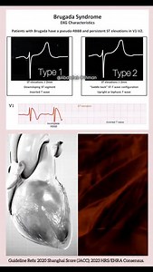 55K views · 511 reactions | Brugada Syndrome: Quick Clinical Guide...