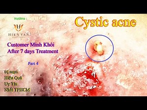 Cách Điều Trị Mụn Viêm, Mụn Bọc Hiệu Quả Nhất TPHCM Tại Hiền Vân Spa _ Minh Khôi I Bài 333