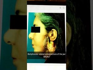 Bisphosphonate related osteonecrosis of jaw necrosis