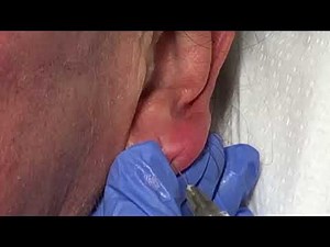 Earlobe Correction With Filler