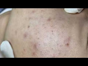 Relaxing daily acne treatment method with Loan Spa#14 | Loan Spa2