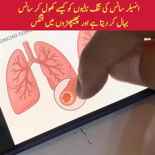 Inhalers containing bronchodilators relax airway smooth muscles, causing bronchodilation, which increases airflow, reduces resistance, and relieves shortness of breath in asthma or COPD. #Asthma #COPD #COPDawareness #inhaler #shortnessofbreath #vasoconstriction #Vasodilation | Dr Shahbaz Akhtar