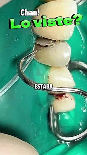 Tecnica Split Dam in Odontologia by Dr. Sebas