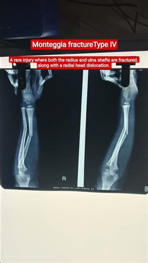 Monteggia fracture #medicosfactz #realpatientcase #childinjury #pediatricorthopedics