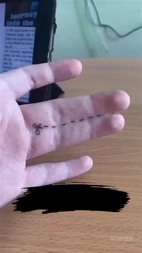 syndactyly #fypage #rosventv