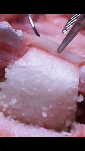 Implant Ninja on Instagram: "From our ninja GBR course, included in the All Course Bundle. What @david.wong.dds taught me during this filming has helped me get predictable outcomes in my practice 🔥"