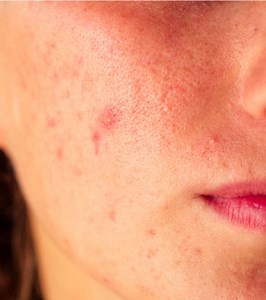 Acne Papules: Your Guide To Causes, Treatments, And Prevention
