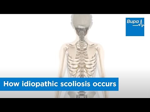 How idiopathic scoliosis occurs | Bupa Health