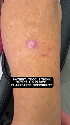 Squamous cell carcinoma (SCC) are a very common skin cancer