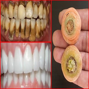 506K views · 5.7K reactions | In 2 minutes, yellow will make dirty teeth white like pearl and shiny. Home remedy for teeth Whitening | ELEGANT BEAUTY | Facebook