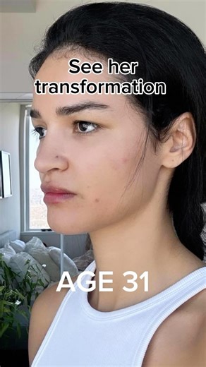 Face fitness transformation My client came to me to get help with hooded naturally, as plastic surgeon wanted to treat them with blepharoplasty. But removing access skin won’t fix the cause. I started working with her through my face fitness SYSTEM and 7 days after, the result was mind-blowing! Join the system! #hoodedeyes #beforeafter #facetransformation #droopyeyes #hoodedeyestruggle #facefitness #facemassage Disclaimer: not a medical advice. For education purpose only. Consult with your physi