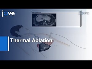 Thermal Ablation For Treatment Of Abdominal Tumors l Protocol Preview
