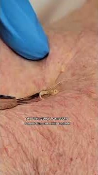 DERMATOLOGIST extracts LARGE yellow CYSTS on chest