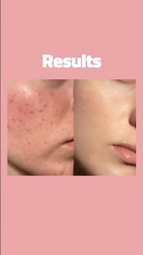 Dark Spots Removal Face Mask | Honey, Milk & Turmeric for Clear Skin