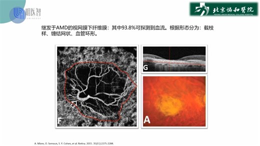 眼科专家张潇教授讲解《常见疾病的0CTA表现》