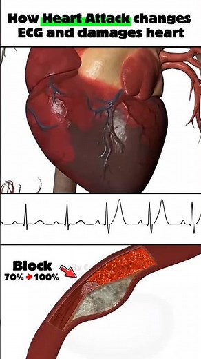 How heart attack changes ECG and damages heart #myocardialinfarction #ecg #blockedarteries