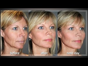 Y LIFT ® 2012 - Renée | Instant, Non Surgical Facelift