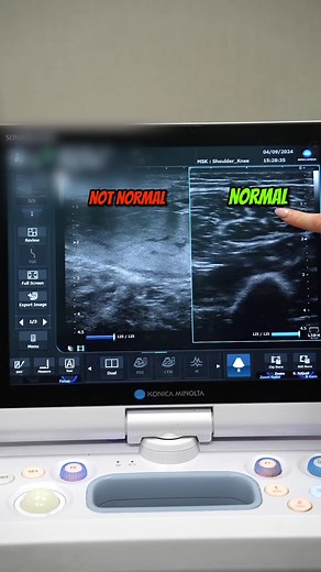 A calf muscle tear is an injury involving damage to the muscles in the back of the lower leg. It often occurs during activities that involve sudden acceleration or changes in direction, such as sprinting or jumping. Symptoms include sharp pain, swelling, and difficulty walking. Treatment usually involves rest, ice, compression, and elevation (RICE), along with physical therapy to aid in recovery and prevent future injuries #painmanagement #arthritis #muscletear #legpain