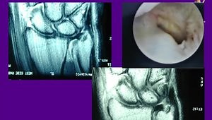 TFCC and Ulnocarpal Impaction: Diagnosis and Treatment
