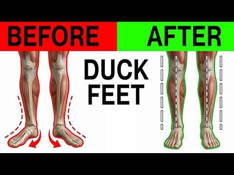 Why You Walk Like a Duck (And How to Fix It)