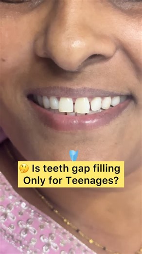 Vijaya the Smile creator🤗🤗 on Instagram: "💁‍♀️Is Gap filling only for Teenagers then you must watch this……. 💁‍♀️Instant gap closure in 30 min 💁‍♀️When you don’t have time for Aligners/Braces 💁‍♀️This is not permanent 💁‍♀️This may stay upto 1-2 years depending upon your teeth and your maintanance 💁‍♀️Per tooth gap Rs 2500-3500 Approximately 💁‍♀️We use Empress to close these gaps 💁‍♀️Book your appointment now 📍 Vijaya Dental Clinic & Implant Centre H No. 1-1-230/20, 1St and 2 nd Floor,
