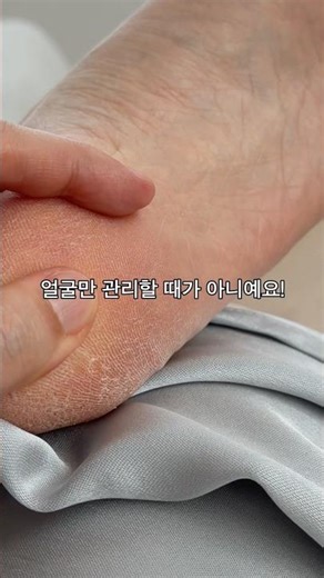 갈라진 발뒤꿈치 7일 안에 완벽하게 #풋케어 #발관리 #발각질관리 #비포앤애프터