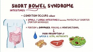 Video: Short bowel syndrome (NORD) - Video Explanation! | Osmosis | Osmosis
