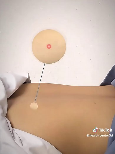 Understanding Bone Marrow Biopsy: A Quick Guide