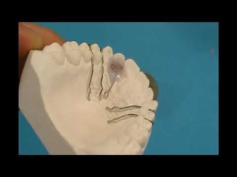 Technique: Fabricating a Hawley Retainer with Spring