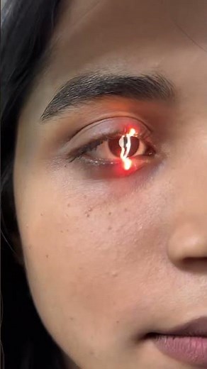 Slit Lamp examination.