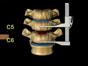 Surgery Midas Rex Drill