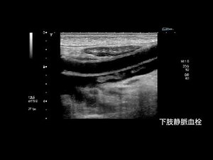 2章-4-図2 下肢静脈にある血栓の確認法