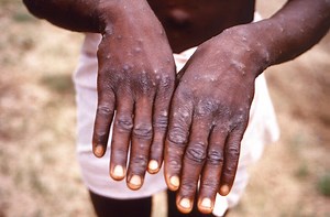 Monkeypox is now a global emergency, UN health agency says